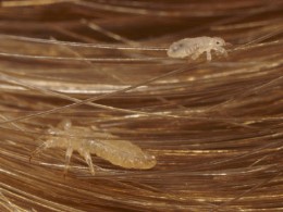 scalp condition- head lice